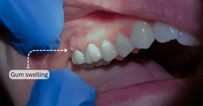 Close-up photo showing gum swelling near the molars caused by infection or irritation.