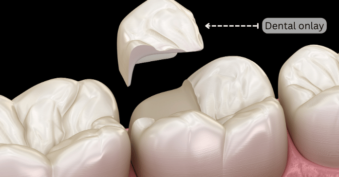 Dental onlay restoration being placed on a damaged molar tooth.