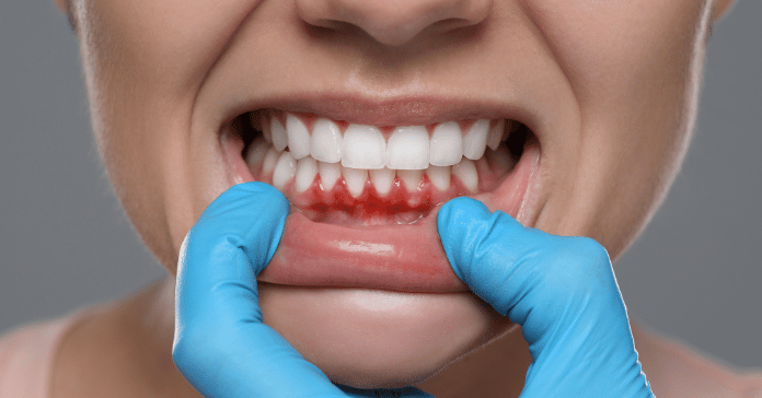 Dentist examining red and inflamed gums showing signs of gingivitis, an early gum disease