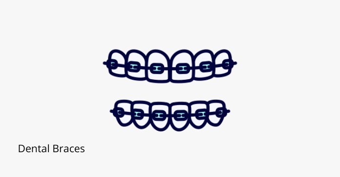 Dental Braces: How Orthodontics Work to Straighten Your Teeth - Share ...