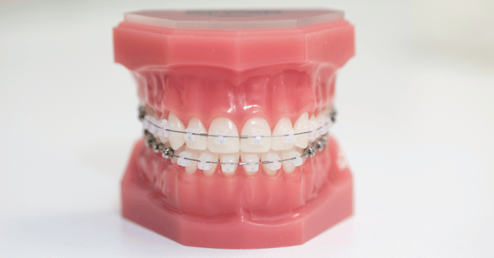 Dental model showing clear ceramic braces on upper and lower teeth.