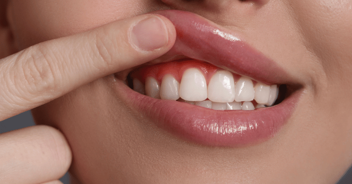 Close-up of healthy smile with a person lifting lip to show clean gums and teeth.