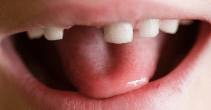 Close-up of a child’s mouth showing gaps where baby teeth have fallen out.