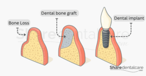 Bone Graft in Tooth: A Guide to Dental Bone Grafting for Implants ...