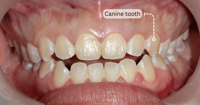 Close-up of upper teeth showing labeled canine tooth for dental anatomy reference.