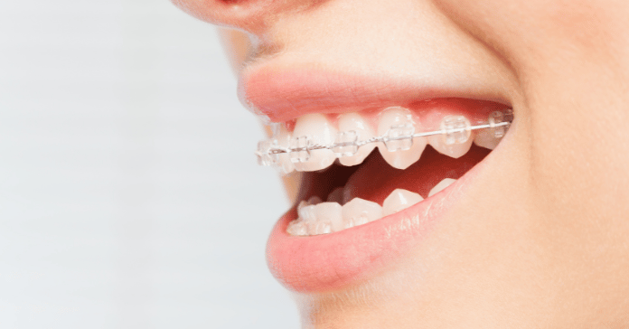 Close-up of clear ceramic braces on upper and lower teeth.
