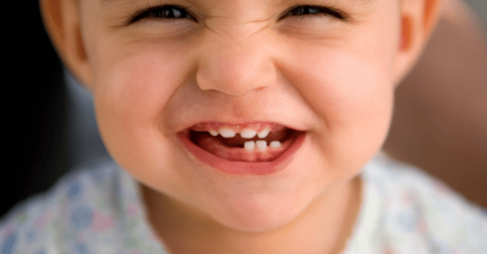 Smiling baby showing newly erupted primary teeth in the upper and lower jaw.