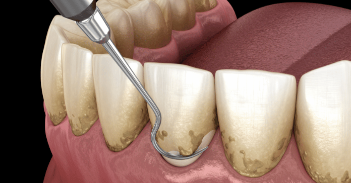 Detailed 3D dental illustration showing a dental scaler removing hardened tartar and plaque from the root surface below the gumline during a scaling and root planing procedure.