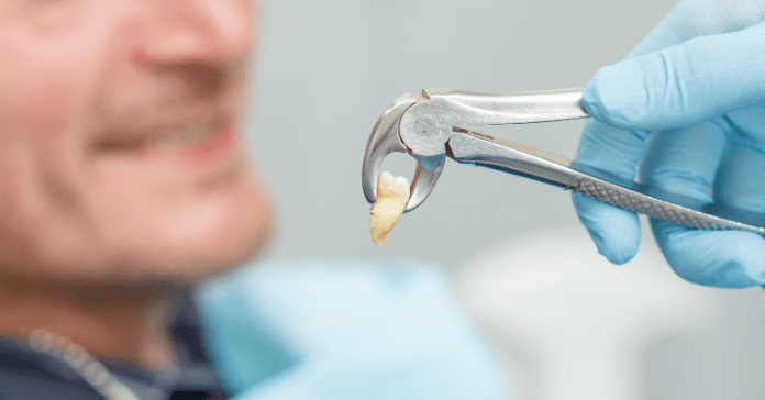 Dentist holding a freshly extracted wisdom tooth with forceps.
