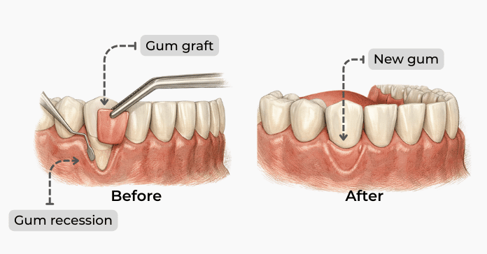 Before and after gum replacement surgery showing a gum graft covering recessed gums and restoring the gum line.
