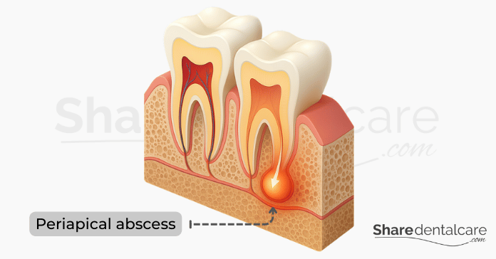 Periapical abscess forming at the tip of a tooth root due to untreated infection.