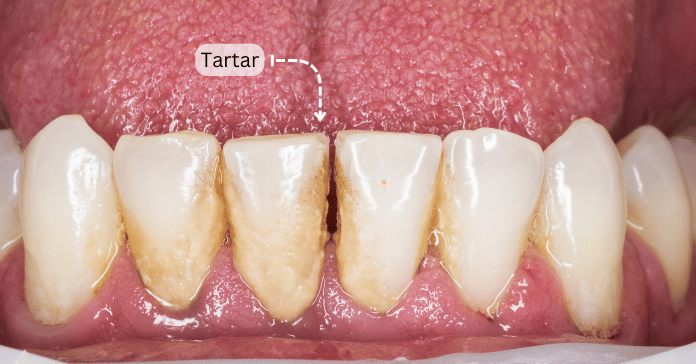 Periogen Dental Tartar Remover Mouthwash - Clinically Proven To Reduce Tartar & Gum Issues