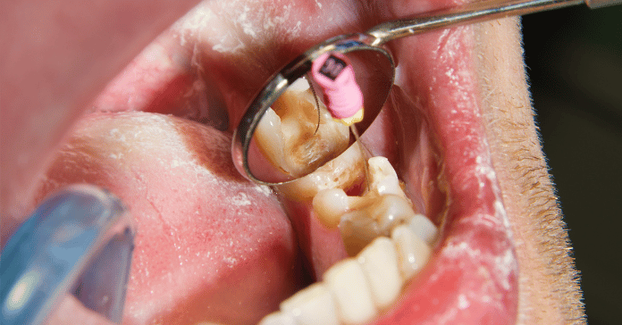 Root canal treatment being performed to remove infected pulp and clean the inside of a damaged tooth.
