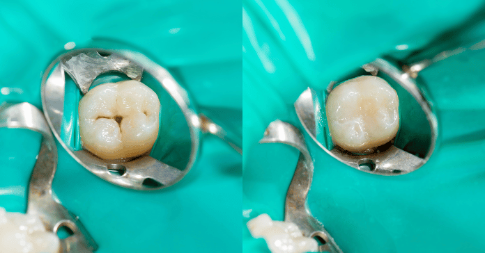 Stages of Tooth Decay: How Cavities Develop Step By Step - Share Dental ...