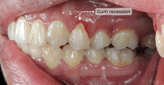 Clinical photo showing gum recession exposing the tooth root and irritated gum tissue.