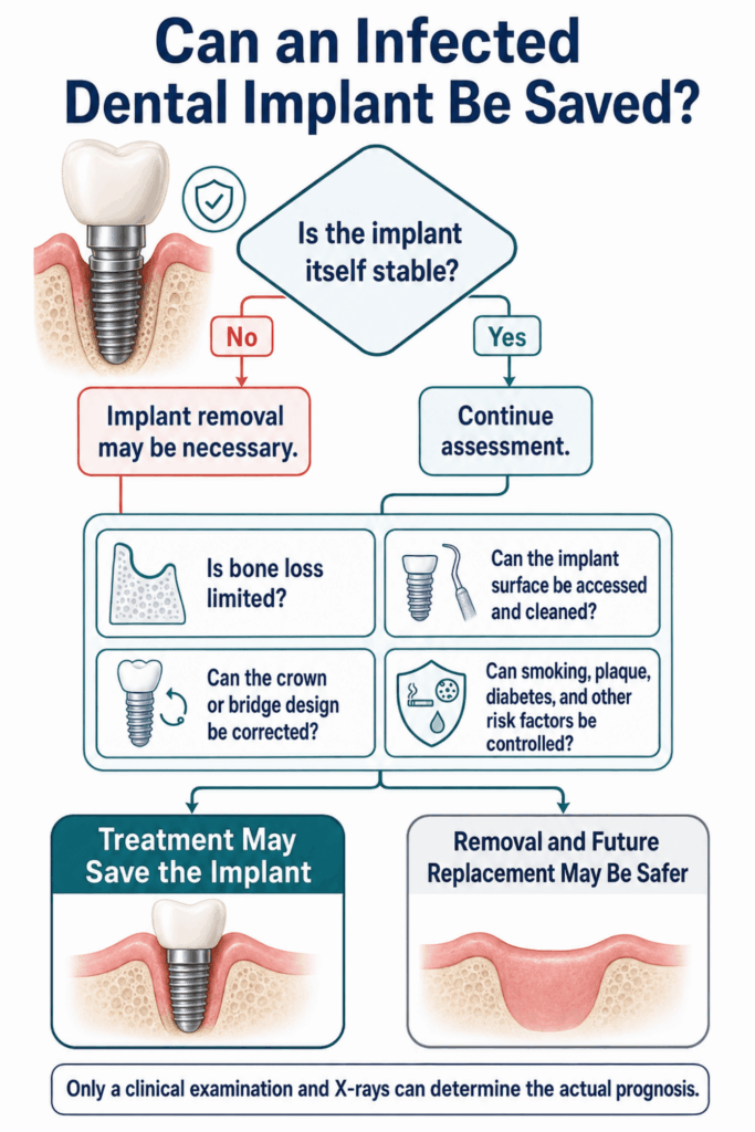 Decision tree checks fixture stability, bone loss, cleaning access, restoration design, and controllable risks