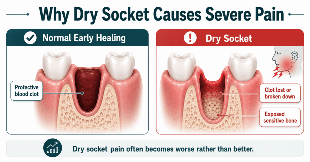 Normal healing socket with a protective blood clot compared with dry socket showing exposed sensitive bone
