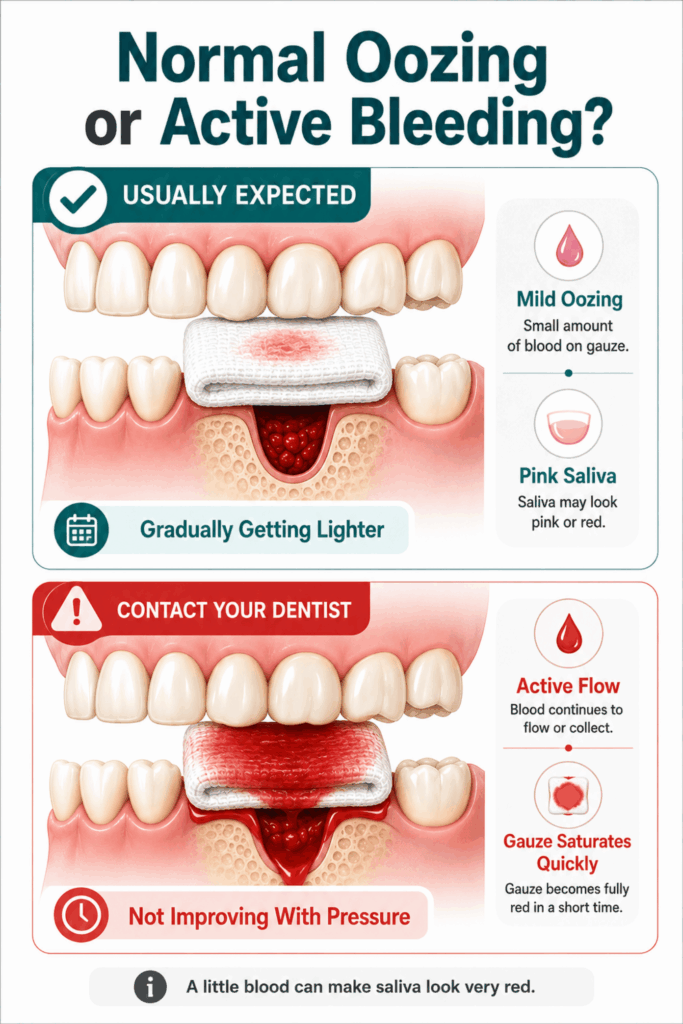 Comparison of mild oozing and pink saliva with active bleeding that quickly saturates gauze after extraction.