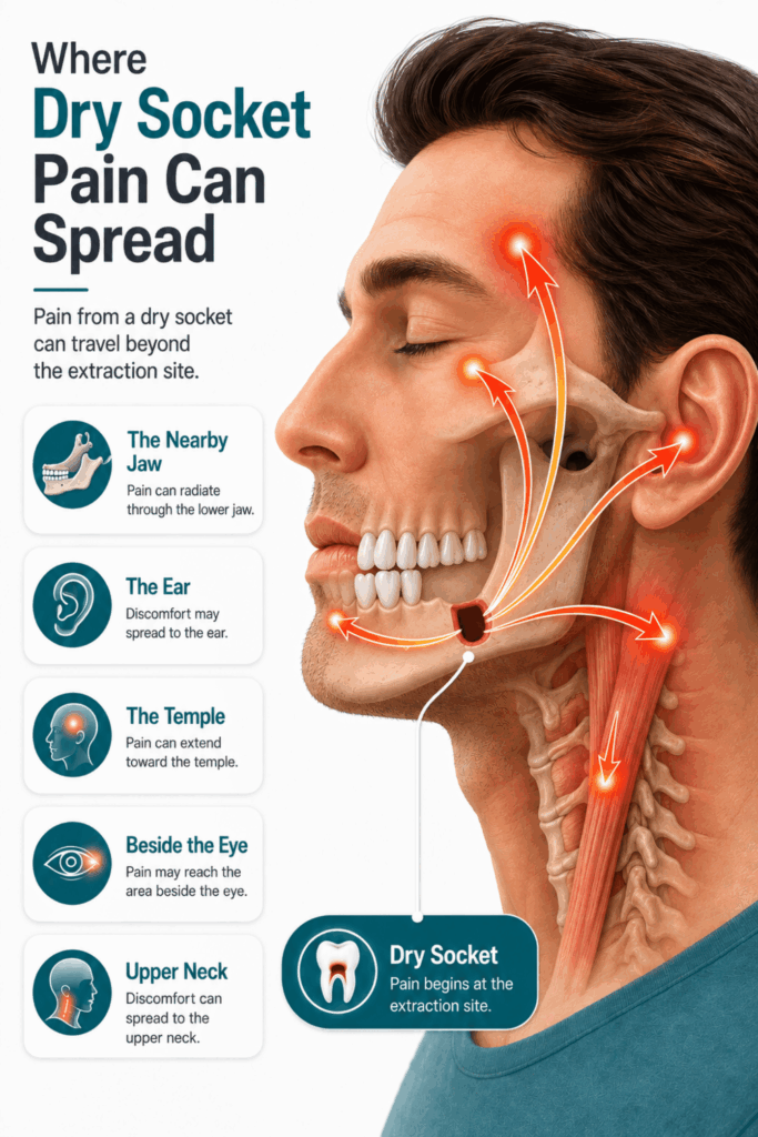 Side-view facial diagram showing pain spreading from a lower extraction site to the jaw, ear, temple, eye, and neck