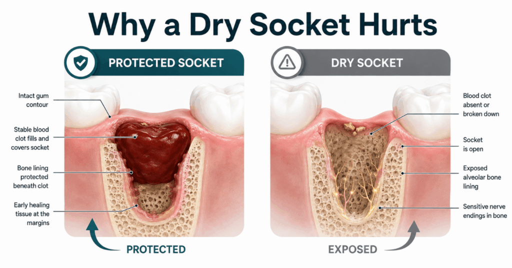 Protected blood clot compared with an open dry socket showing exposed bone and sensitive nerve endings