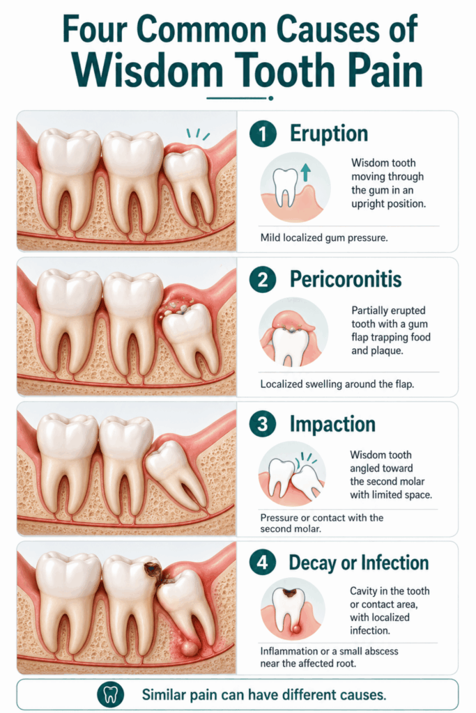 Four-panel diagram showing wisdom tooth eruption, pericoronitis, impaction, and decay or infection