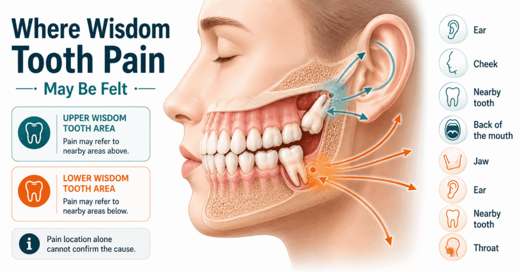 Head and jaw diagram showing upper and lower wisdom tooth pain spreading toward the ear, cheek, jaw, throat, and nearby teeth